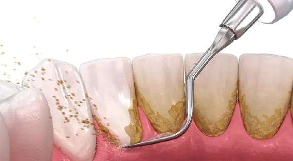 Pan Dentistry – Family Dentistry & Dental Implant Specialist in Issaquah, WA